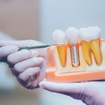 Smile Saver: 5 Essential Care Tips for Dental Implants